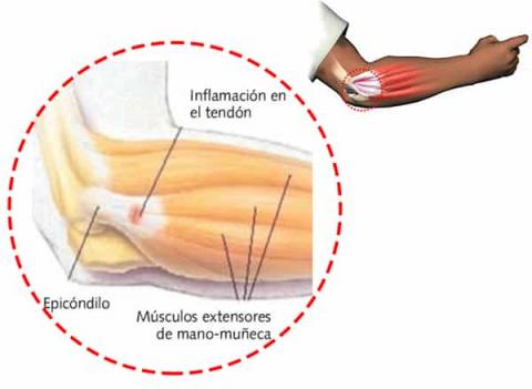 Neuromodulacion Percutanea en Patologia Aquilea y Epicondilea