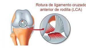 Plastia LCA