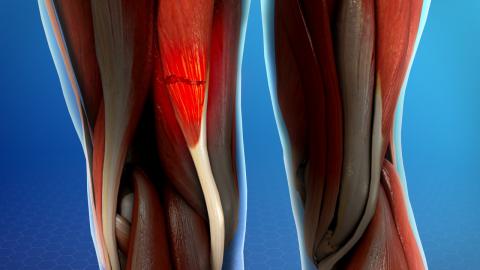 Lesiones Musculares