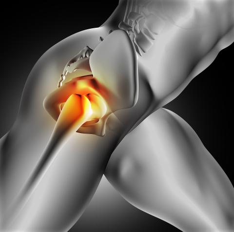 Fisioterapia en el Choque Acetabular